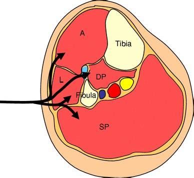 circumferential compression test physiopedia|Compartment Syndrome of the Lower Leg .